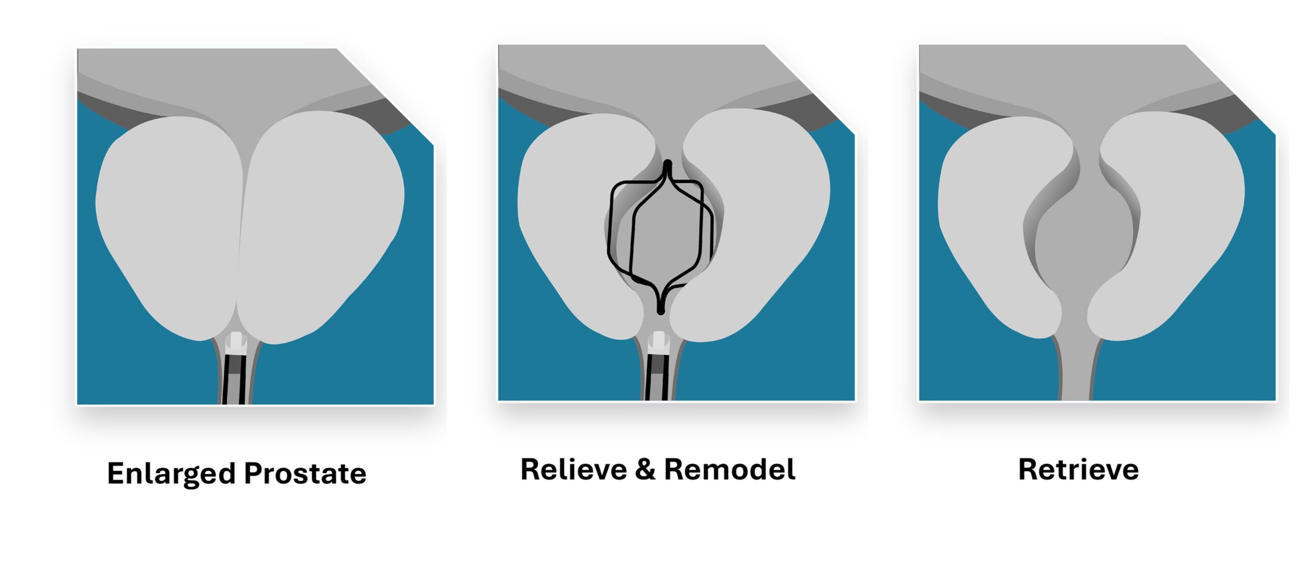 Prodeon Medical Receives FDA 510(k) Clearance for the Urocross® Expander System, a Novel Non-Permanent Retrievable Implant for Treating Urinary Symptoms Associated with Benign Prostatic Hyperplasia